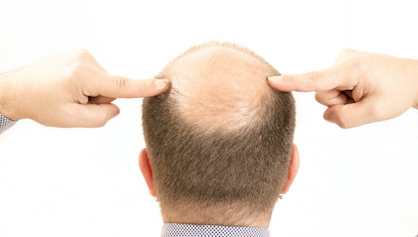 Haarwachstum Kopfhaut Mann behandlungen